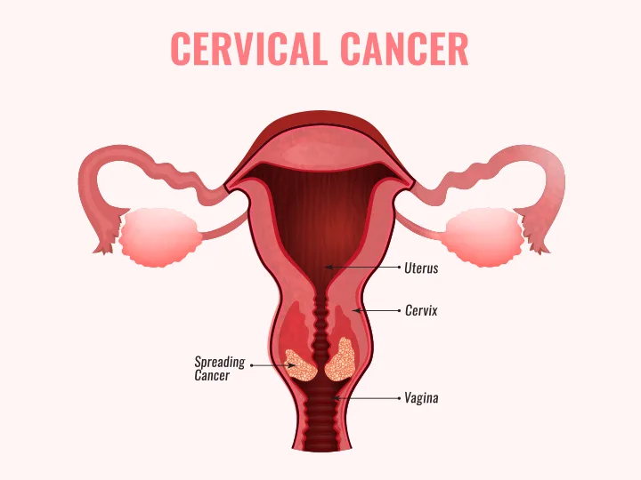 Pap Smear and Cervical Cancer Screening Thane